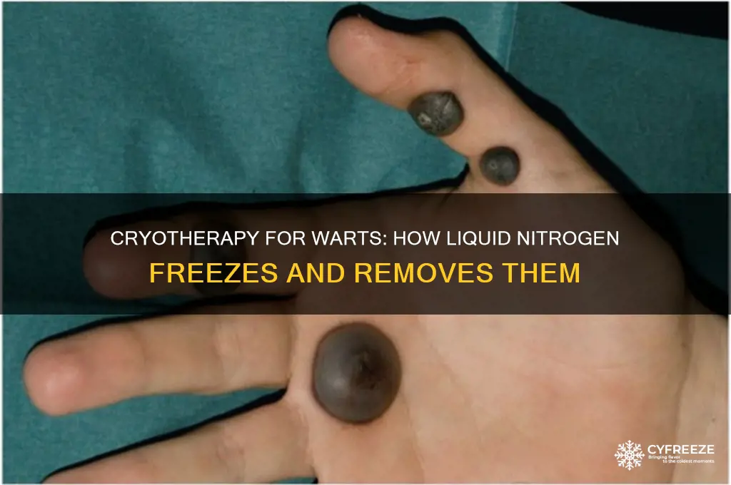 what element is used to freeze of warts