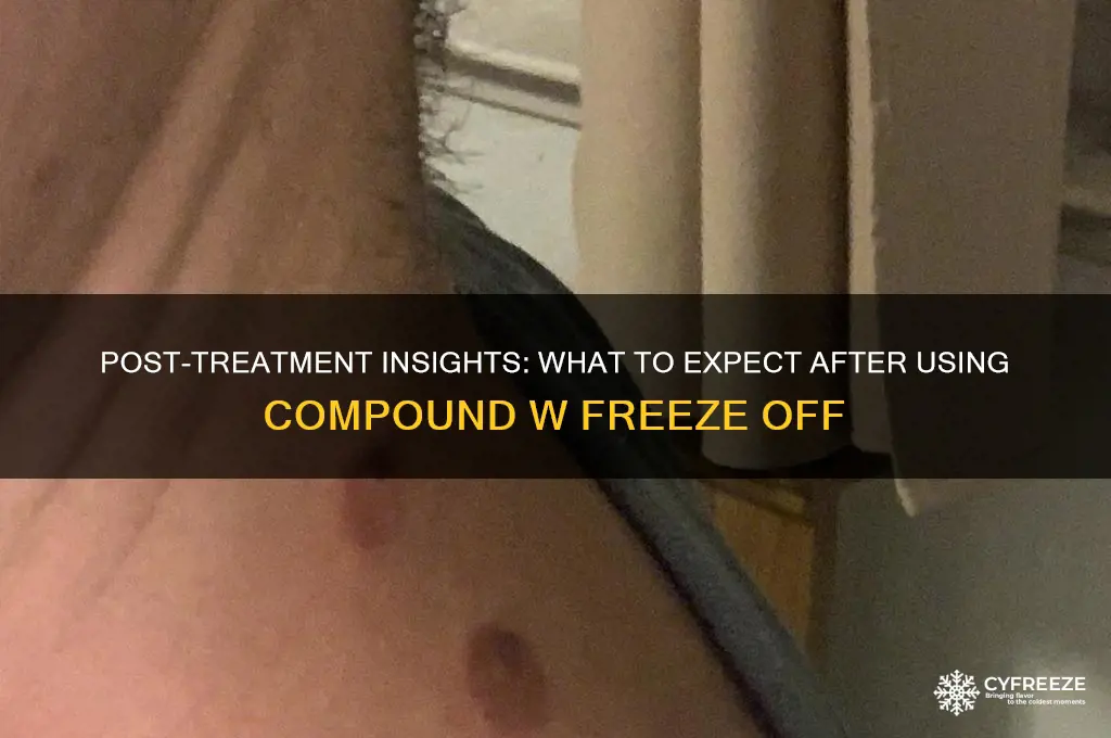 what happens after using compound w freeze off