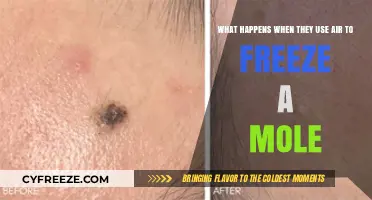 Freezing Moles with Air: The Cryotherapy Process Explained