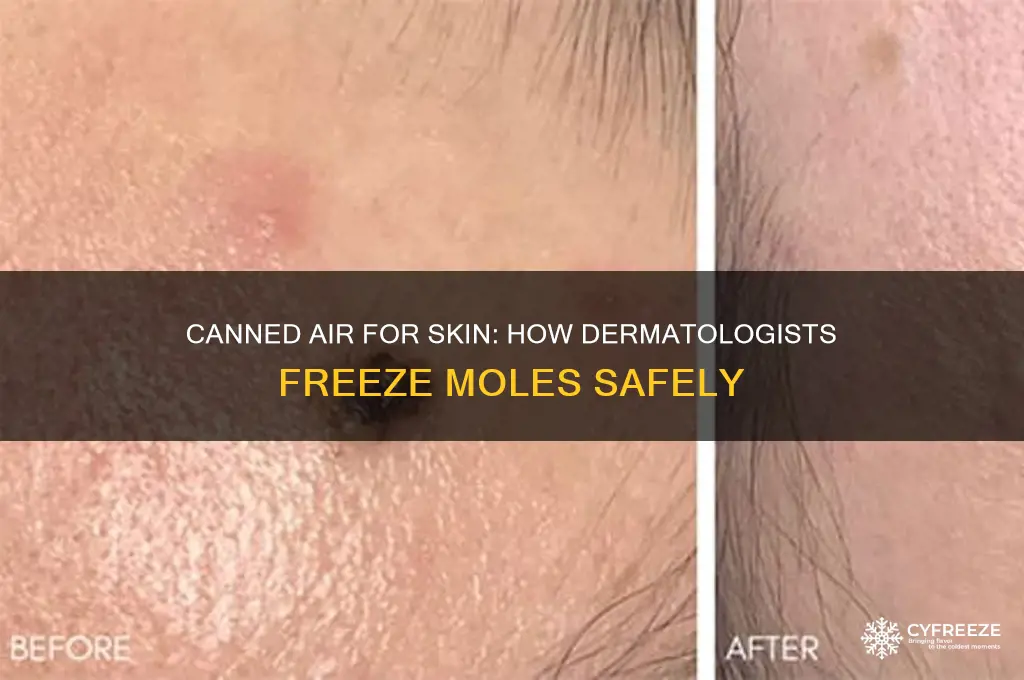 what is the canned air dermatologists use to freeze miles