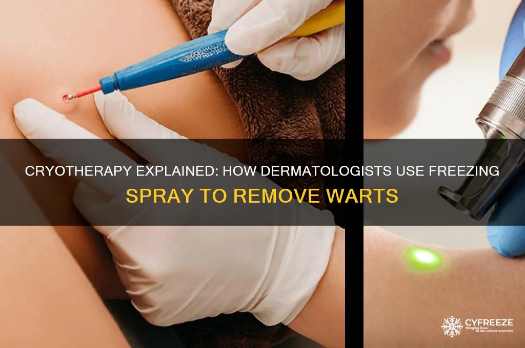 what is the freezing spray dermatologists use to kill warts