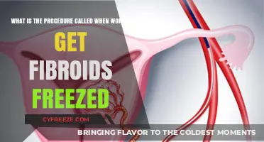 Understanding Uterine Fibroid Embolization: Freezing Fibroids for Women's Health