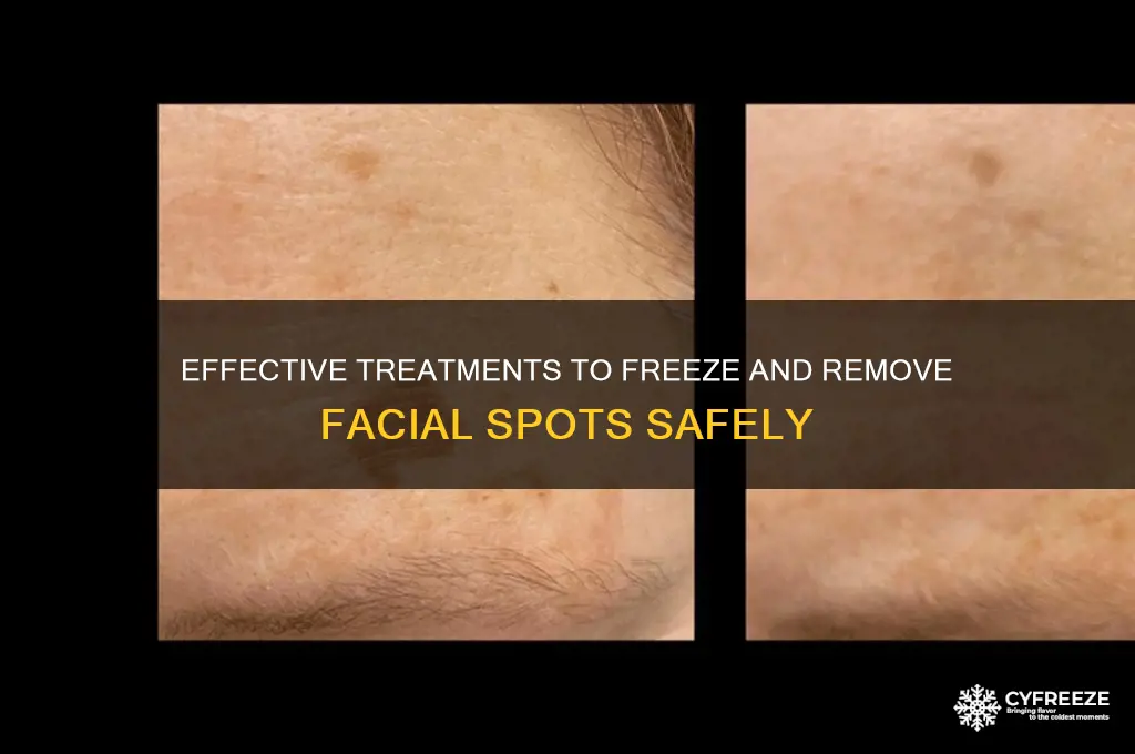 what is used to freeze facial spots