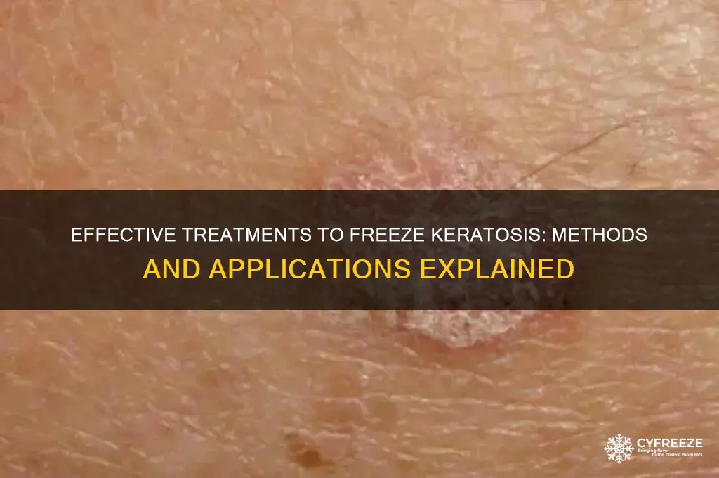 what is used to freeze keratosis