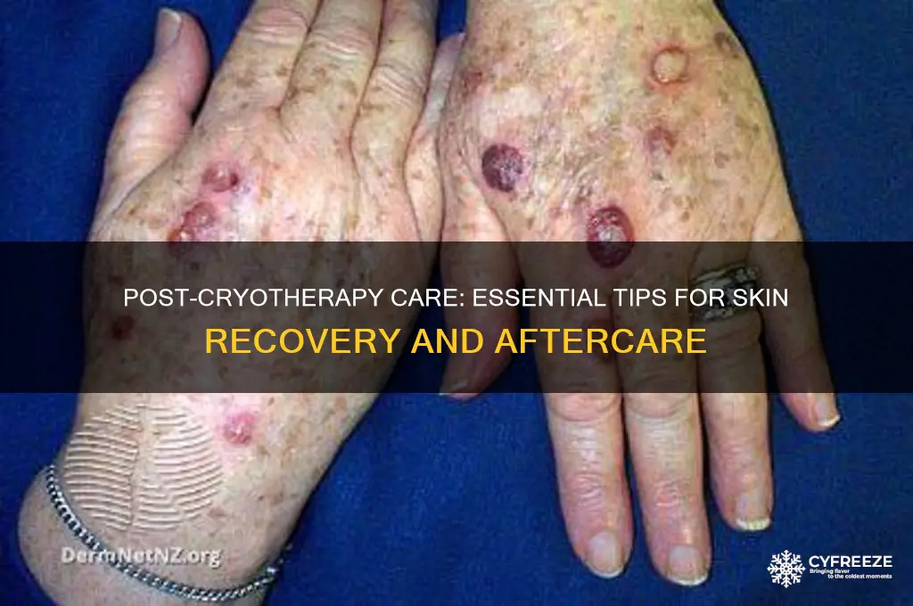 what to use after freezing therapy
