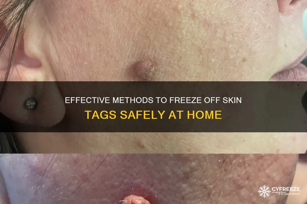 what to use to freeze off skin tags