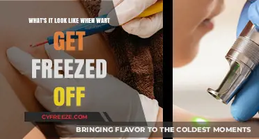 Freezing Off Warts: A Visual Guide to the Cryotherapy Process