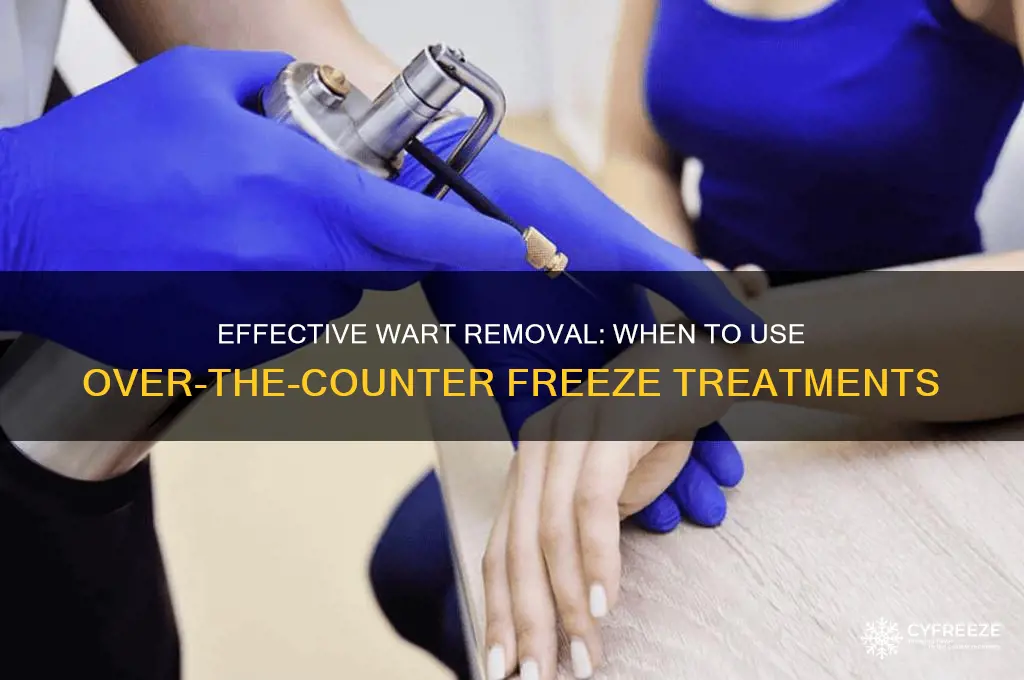 when to use over the counter wart freeze