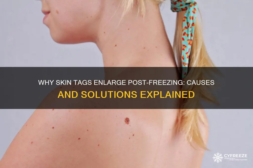 why did my skin tag get bigger after freezing