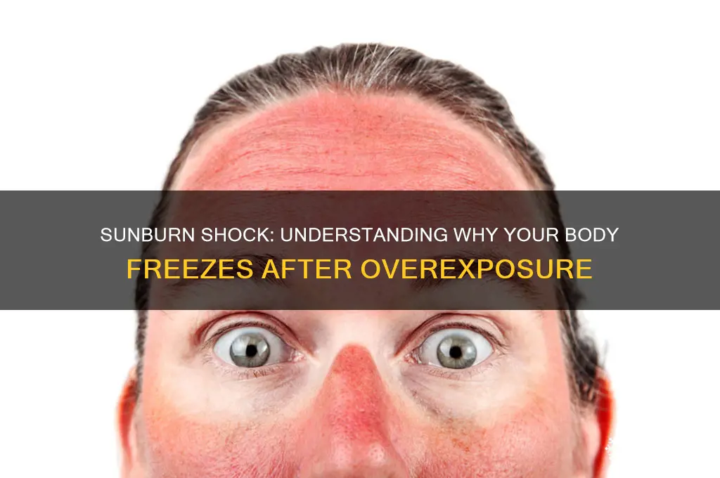 why do you freeze after getting sunburn