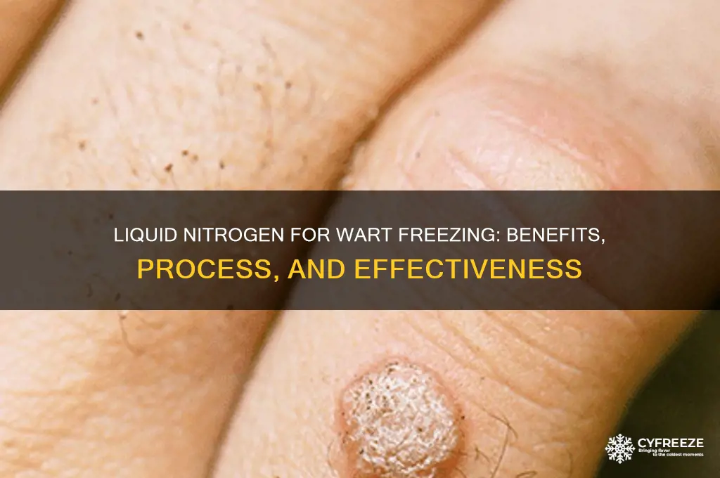 why is liquid nitrogen used for freezing warts